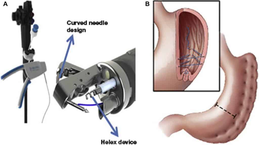 Apollo Endoscopic Sleeve Gastroplasty